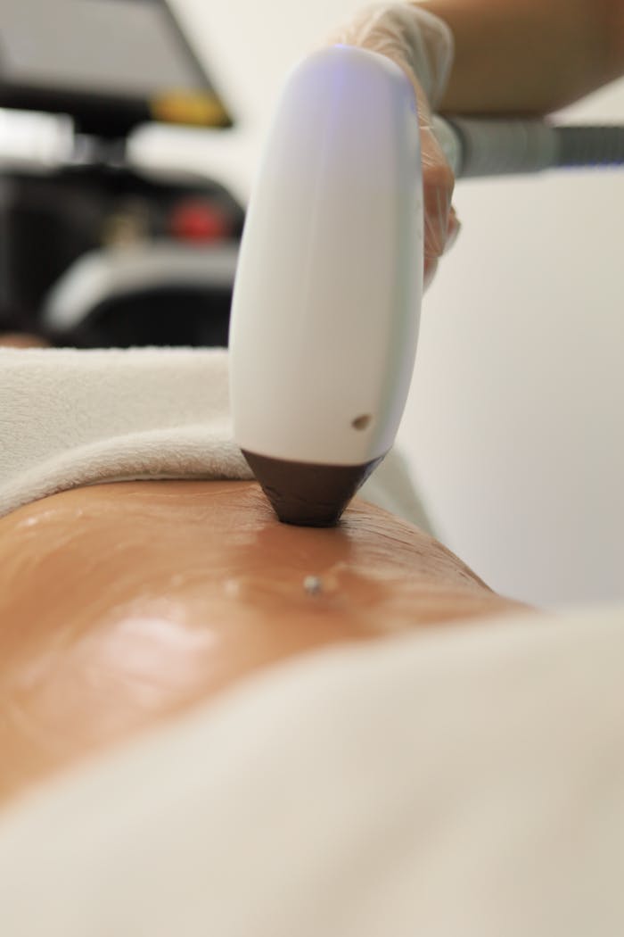Services Detailed view of a laser treatment on skin at a medical clinic in İstanbul.